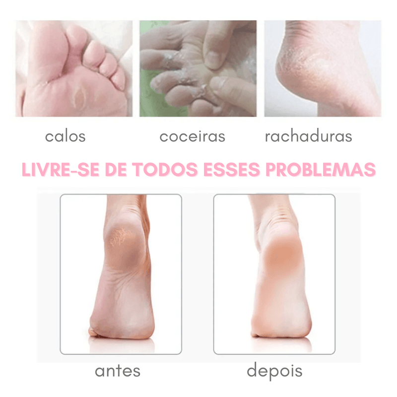 Removedor de Calos e Rachaduras - Soft Feet